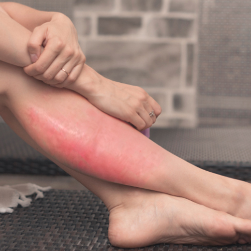 Celulitis de la piel