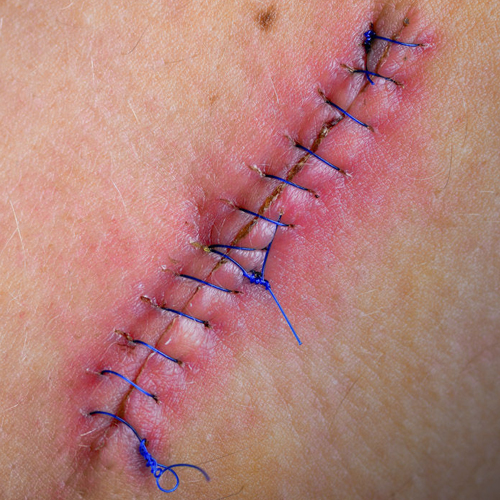 Suturas de heridas